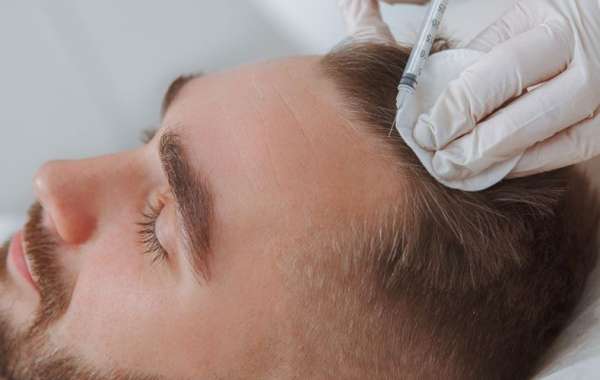 Hair Transplant Los Angeles Cost