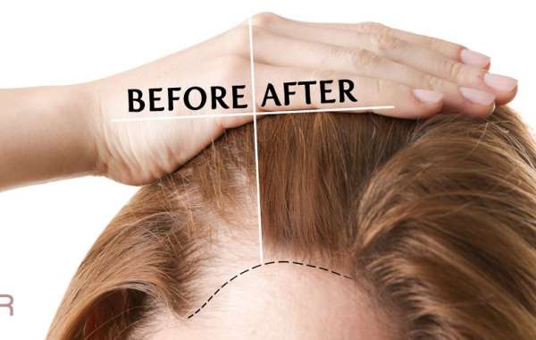 Can Stress Cause Hair Loss