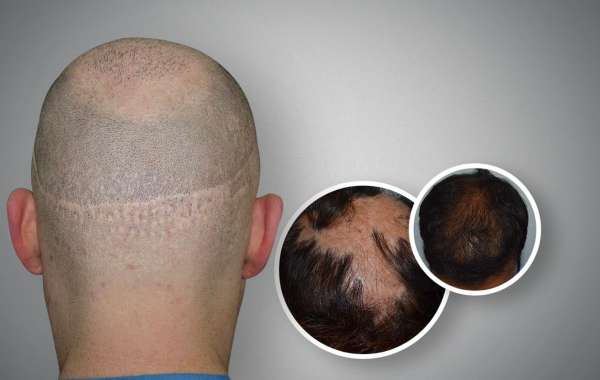 Hair Transplant Surgery Fue