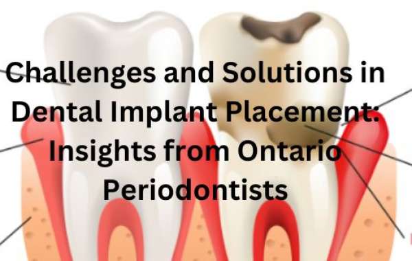 Challenges and Solutions in Dental Implant Placement: Insights from Ontario Periodontists