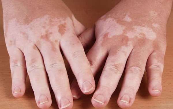How to Stop Vitiligo From Spreading?