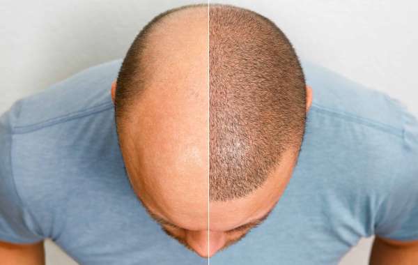 Exploring Hair Transplant Costs in Delhi: What You Need to Know