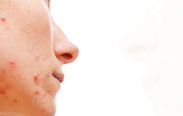 Acne: FAQs and Treatment Options