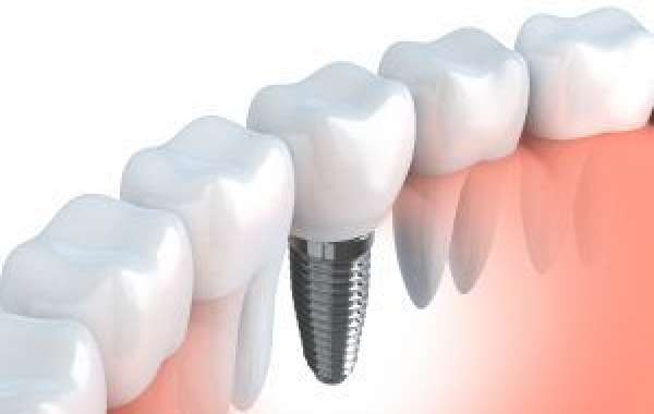 Unlocking Your Perfect Smile: Everything You Need to Know About Dental Implants in Grantham