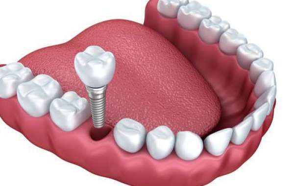 Comprehensive Guide to Full Arch Implants in Derby: Everything You Need to Know