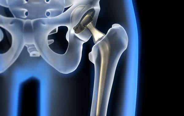 Hip Implants Market Trends, Size, Segment and Industry Growth by Forecast to 2030