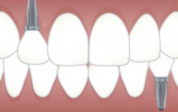 The Ultimate Guide to Dental Implants: Everything You Need to Know