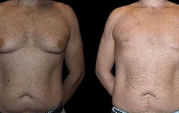 Different Techniques for Male Breast Reduction Surgery