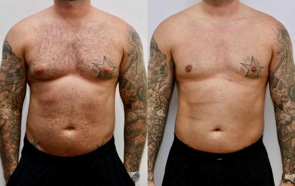 Gynecomastia Surgery and the Power of Positive Visualization for Recovery