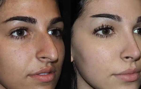 Combining Rhinoplasty with Other Facial Procedures for Total Harmony in Dubai