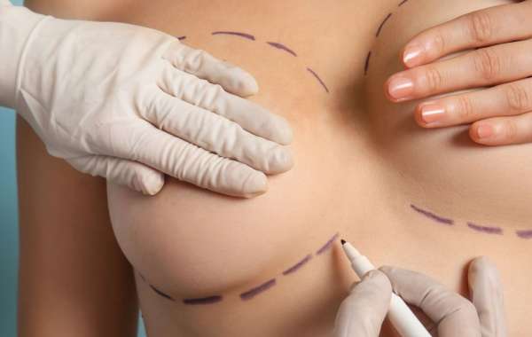 Managing Expectations Before Breast Fat Transfer Surgery