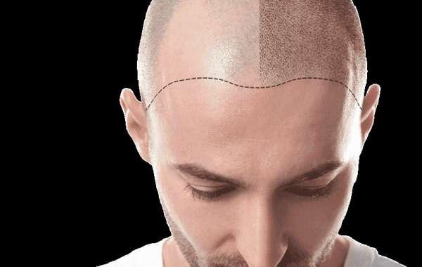 Revitalize Your Look with Scalp Micro Pigmentation