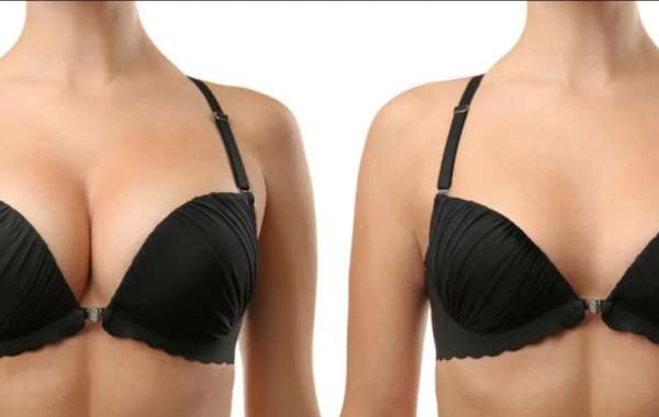 Breast Reduction Surgery in Pune - Dr. Shilpy Dolas