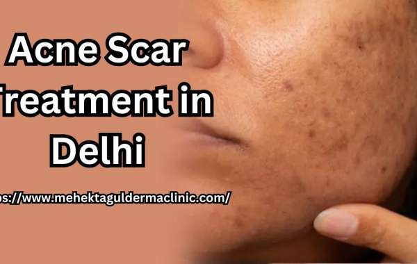 How Dermal Fillers Remove Acne Scars?