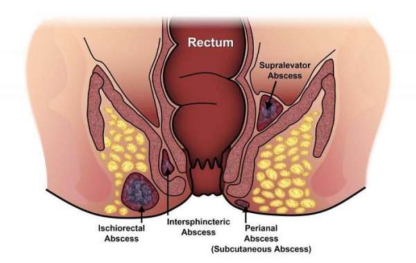 The Ultimate Guide to Finding the Best Fistula Surgeon in Mumbai