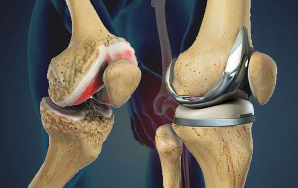 Finding the Right Surgeon for Your Knee Replacement in Delhi