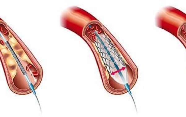 Peripheral Angioplasty in Jaipur: Restoring Blood Flow