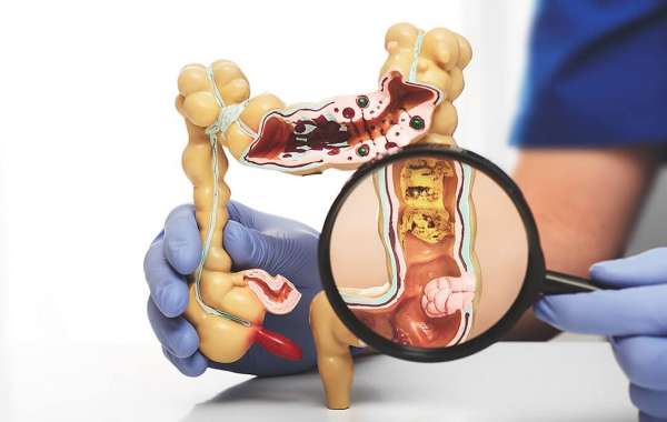 Make Your Health For Best Decision To Choosing Colorectal Surgeon Mumbai