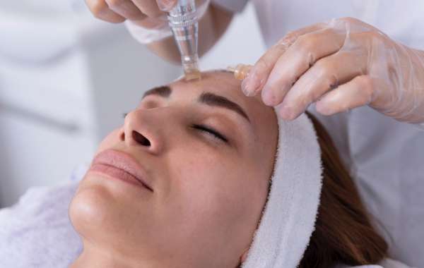 Needle to Nirvana: Unlocking Skin's Radiance with PRP Microneedling