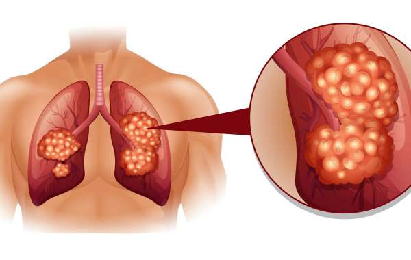 Lung Cancer Screening Market Demand, Growth Factors, Trend & Forecast to 2030