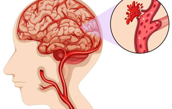 BioScan Research: Advanced Solutions for Intracranial Hemorrhage Detection