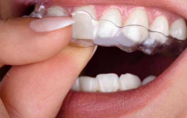 Teeth Straightening: Exploring Modern Options for a Perfect Smile