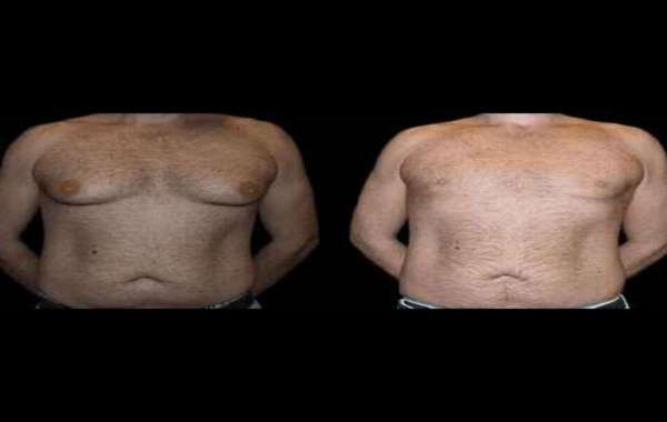 Common Myths About Gynecomastia Surgery: Insights from the Best Surgeons in Dubai