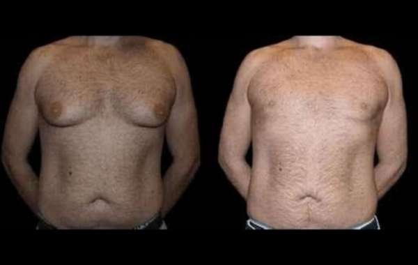 Trust the Best Doctors in Dubai for Exceptional Gynecomastia Results