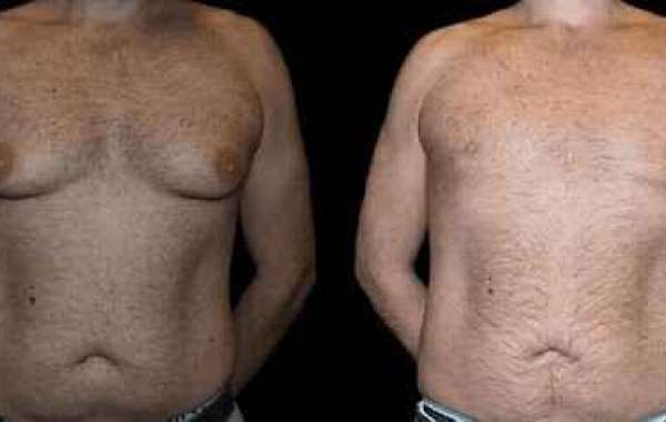 Is Gynecomastia Surgery Right for You? Advice from the Best Gynecomastia Doctors in Dubai