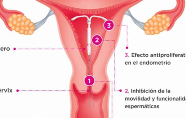 Descubre la Hormona Clave: ¿Qué Hay Detrás del DIU Mirena?