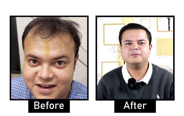 Affordable Hair Loss Treatments in Delhi: Options for Every Budget