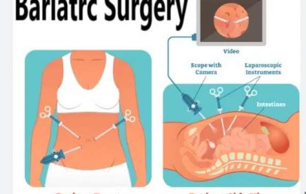 Bariatric Surgery for Weight Loss in Delhi | Weight Lose Clinic