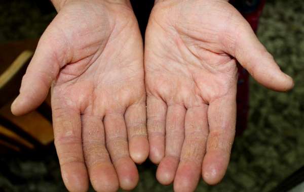 Clinical Trials for Palmoplantar Keratoderma: Latest Developments and Insights