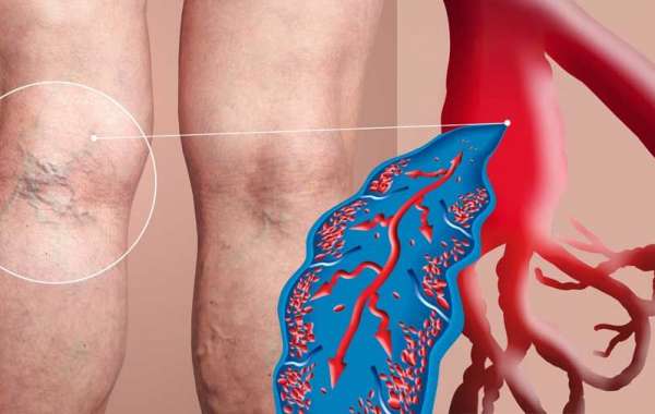 Rising Prevalence of Venous Disorders Boosts Demand for Varicose Veins Treatment Solutions