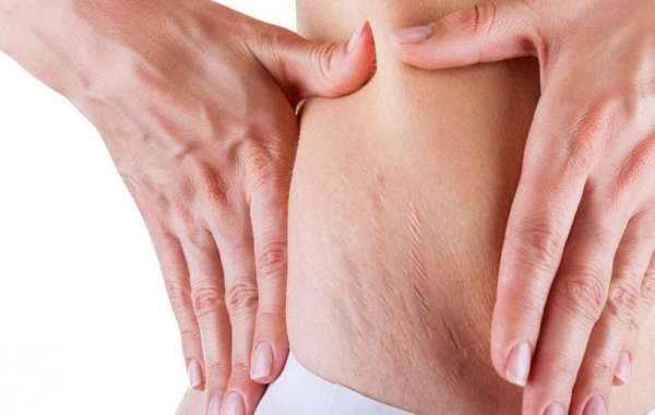 How to Deal With Pregnancy Stretch Marks?