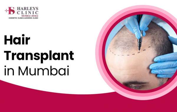 5 Benefits of FUE Hair Transplant Surgery