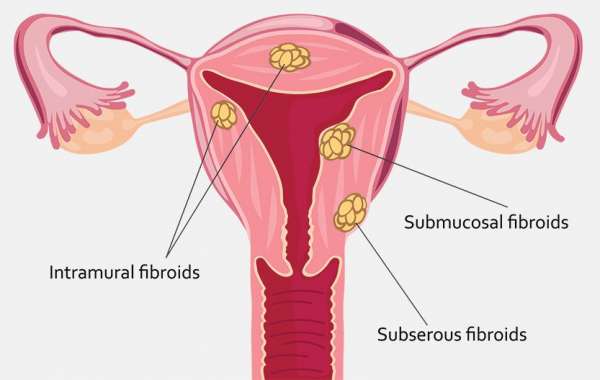 Understanding Fibroid Surgery: A Key to Women’s Health