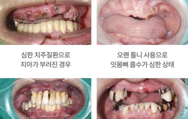 치과 클리닉의 탁월한 임플란트 치료