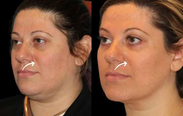 "What to Expect from the Best Sculptra Dermatologists in Dubai"