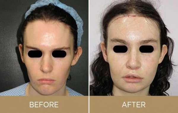 What is Nose Feminization Surgery?