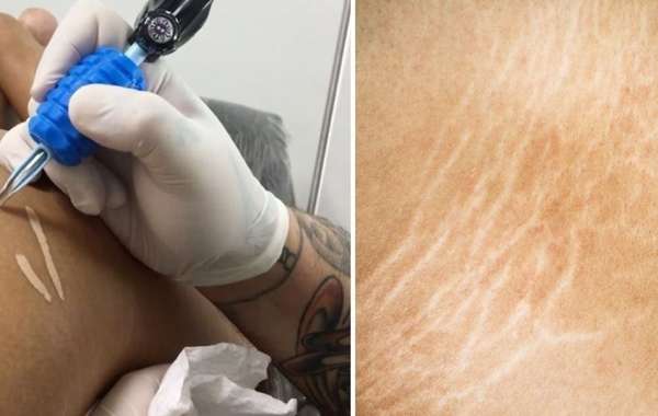 Tattoo Removal And Tattoo Over Stretch Marks