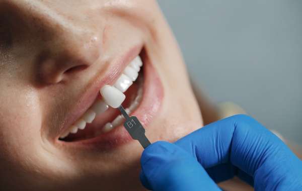 Composite Bonding: The Modern Solution for a Perfect Smile