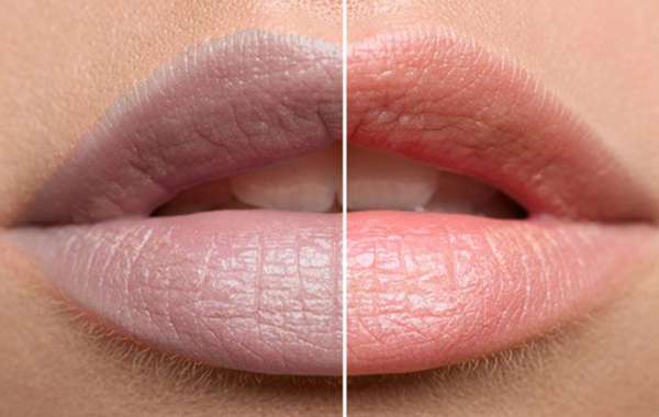 Effective Dark Lips Treatment and Lip Lightening Treatments: A Complete Guide