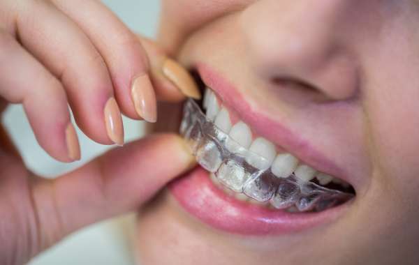 Invisalign: Revolutionising Orthodontics with Clear Aligners