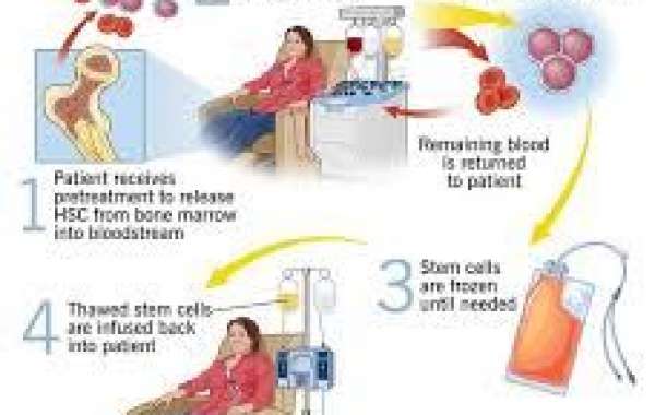 Stem Cell Therapy for Infertility in Turkey: A Revolutionary Treatment Option