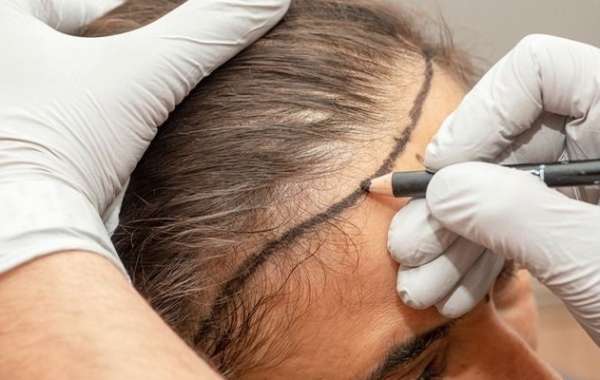 Top 5 Reasons Women Experience Hair Fall