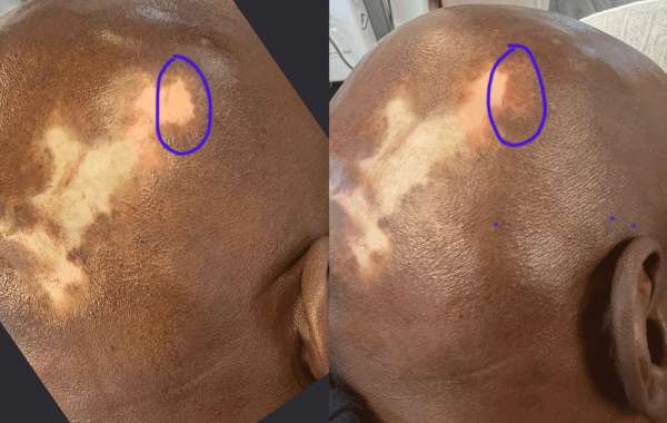 How do Vitiligo Tattoos Differ from Regular Tattoos?
