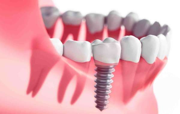 Best Clinics for Dental Implants in Dubai – Book Now