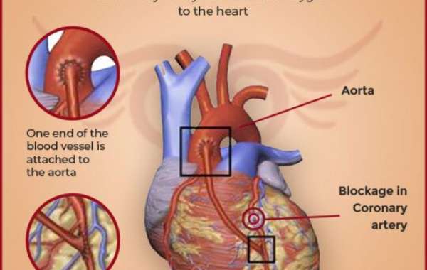 Best Bypass Surgeon in Delhi