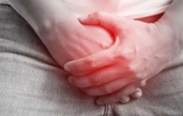 Natural Relief for Varicocele: Homeopathic Solutions Without Surgery